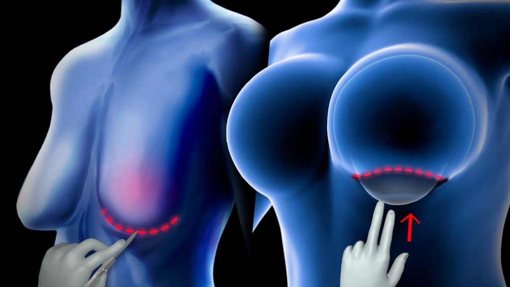 How Breast Enlargement Surgery is Carried Out in 1 Hour