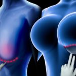 How Breast Enlargement Surgery is Carried Out in 1 Hour